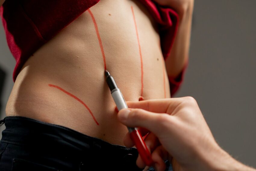 doctor preparing for tummu tuck